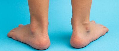 Sever’s: A Heel Dilemma