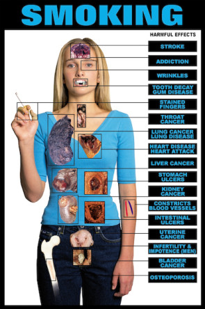 Harmful Effects of Smoking Chart, Laminated 24" x 36"