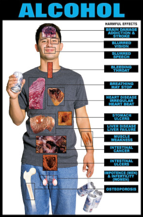 Harmful Effects of Alcohol Chart, Laminated 24" x 36"
