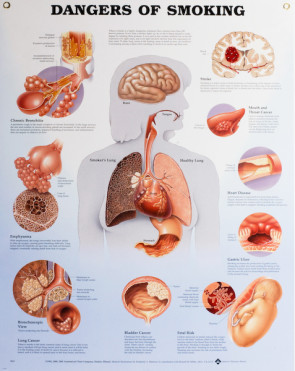 Dangers of Smoking Chart, Laminated 20" x 26"