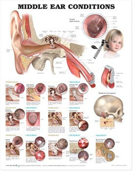 Chart, Laminated 20" x 26", Middle Ear Conditions