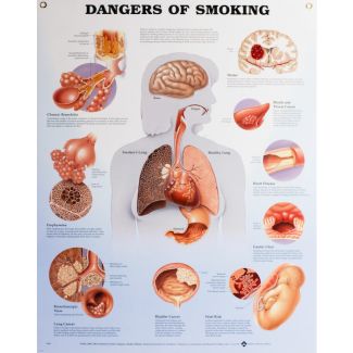 Dangers of Smoking Chart, Laminated 20" x 26"