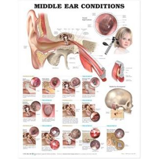 Chart, Laminated 20" x 26", Middle Ear Conditions